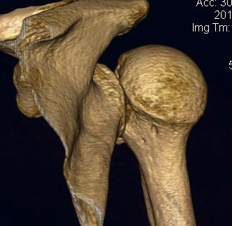 Posterior Shoulder Dislocation CT 1